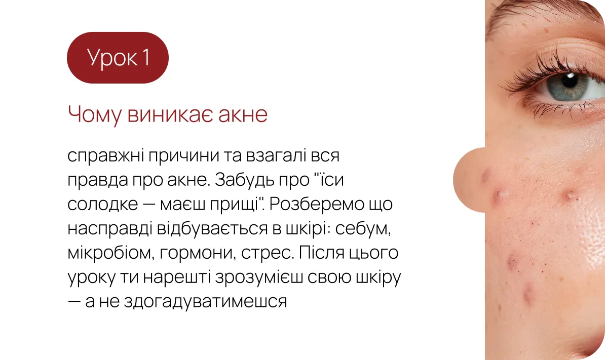 Урок 1. Чому виникає акне